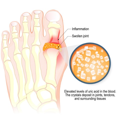 uric acid X-ray graphic